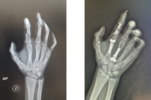 Fractura de muñeca y mano